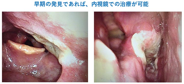 早期の発見であれば、内視鏡での治療が可能