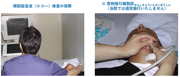 頸部超音波検査の実際