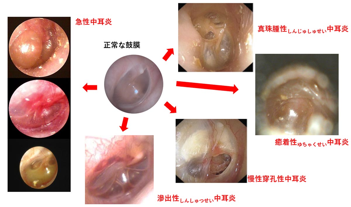 いろいろな中耳炎