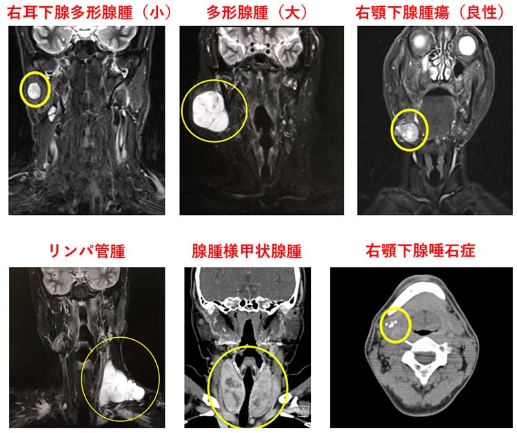いろいろな頸部腫瘍