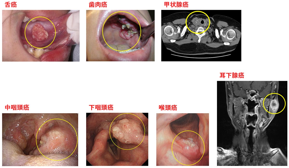 悪性腫瘍（癌）の症例