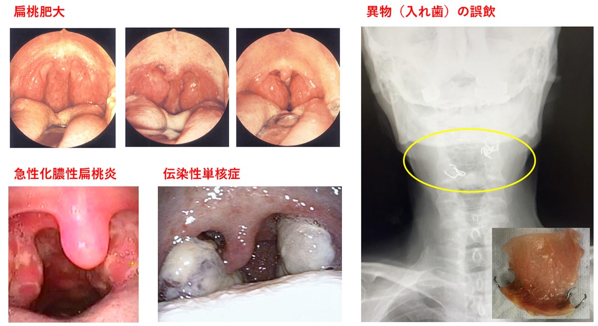いろいろな扁桃腺、咽頭の病気