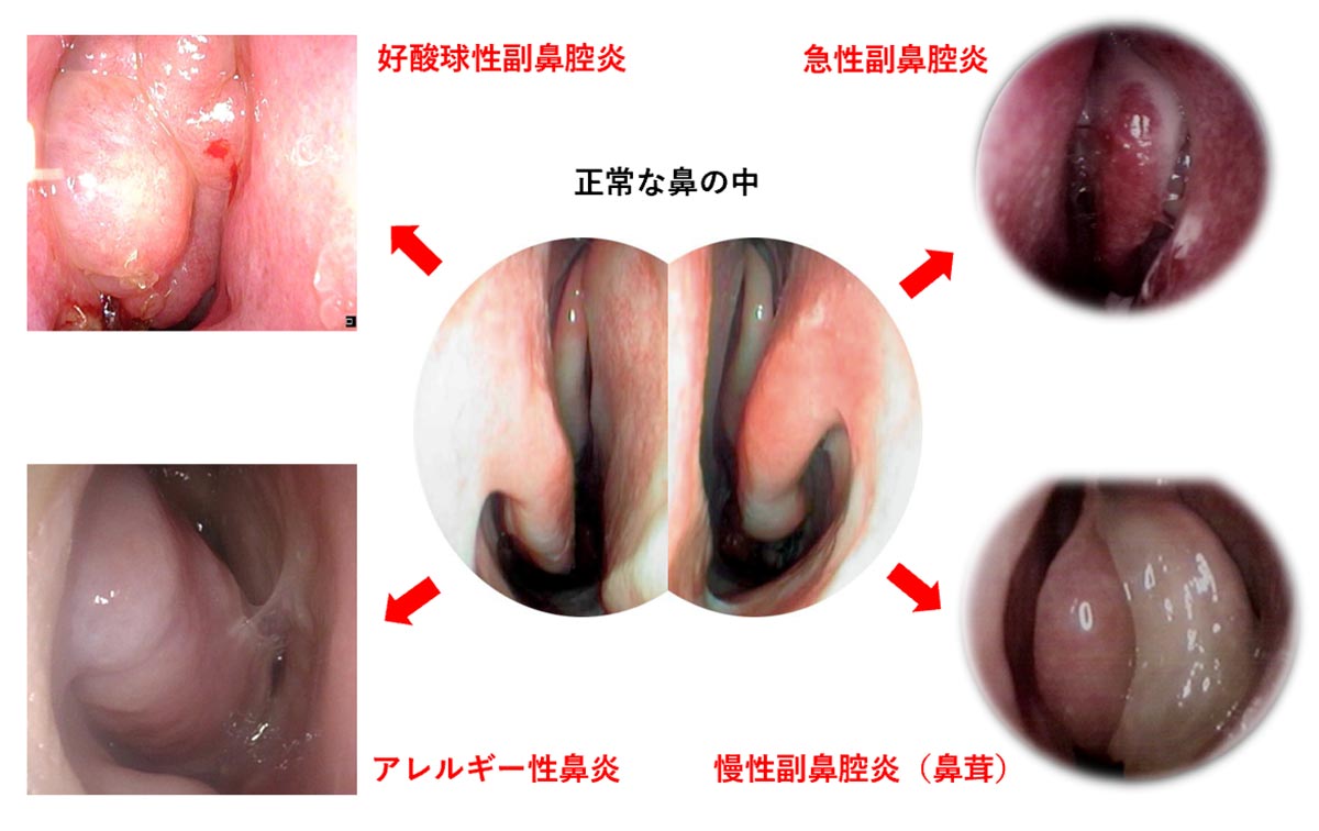 いろいろな鼻（副鼻腔）の病気