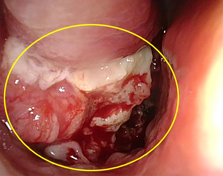 鼻副鼻腔癌症例写真