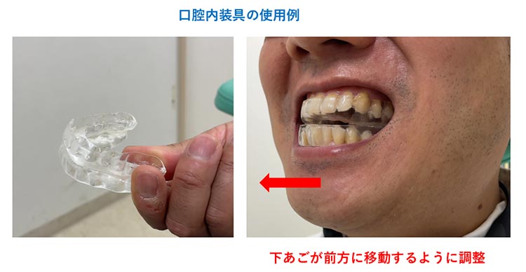 口腔内装具の使用例